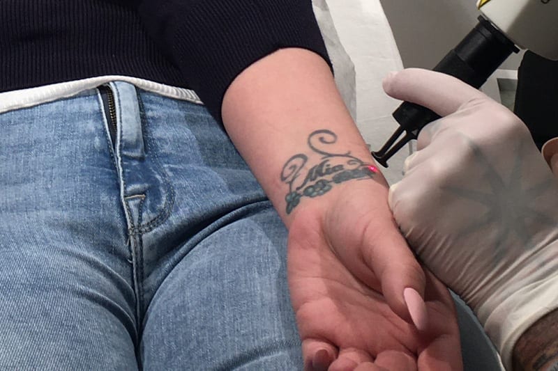 Behandling med laser af tattovering