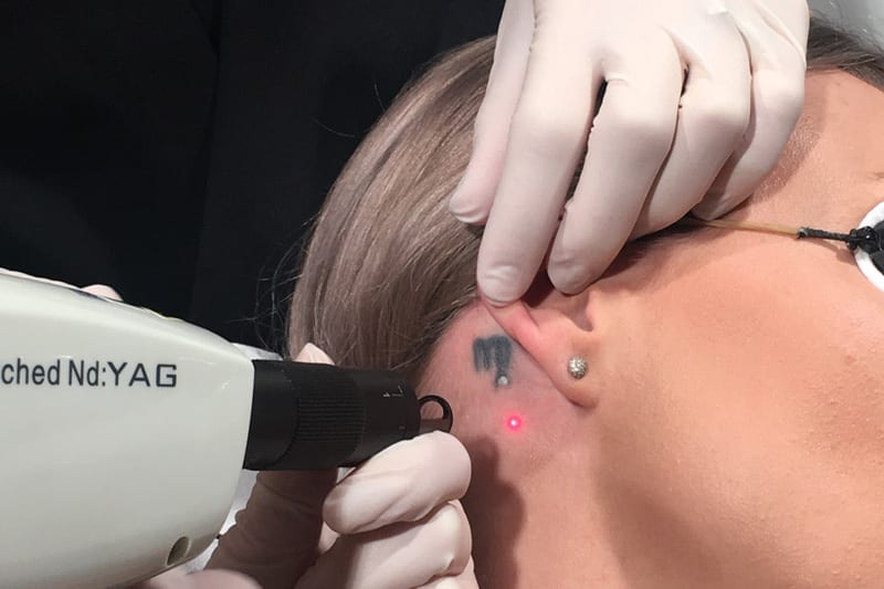laserbehandling af tattovering